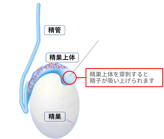 MESA（精巣上体精子採取術）のイメージ